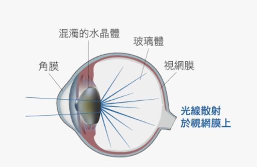 白內障手術—水晶體種類太多了！！到底如何選？