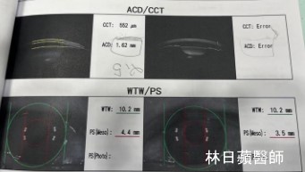 飛秒雷射輔助白內障手術